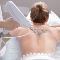 The Ultimate Guide to Choosing the Best Tattoo Removal Machine