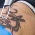 The Ultimate Guide to FDA-Approved Tattoo Removal Machines