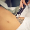 The Ultimate Guide to Choosing the Perfect Tattoo Removal Machine