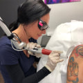 The Ultimate Guide to Choosing the Best Tattoo Removal Machine