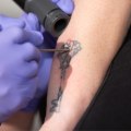 The Advancements in Tattoo Removal Technology