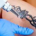 The Ultimate Guide to Choosing the Best Tattoo Removal Machine: An Expert's Perspective