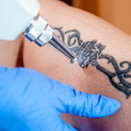 The Ultimate Guide to Tattoo Removal Machines: Can They Completely Remove a Tattoo?