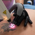 The Best Tattoo Removal Machine: What You Need to Know