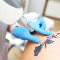 The Ultimate Guide to Tattoo Removal: How to Achieve Optimal Results with the Best Tattoo Removal Machine?