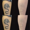The Cost Comparison: Tattoo Removal Machine vs. Cover-Up Tattoo - Which is the Better Option?