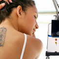 The Truth About Tattoo Removal Machines: Is it Worth the Cost?
