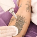 The Ultimate Guide to Removing Tattoos in Hard-to-Reach Areas