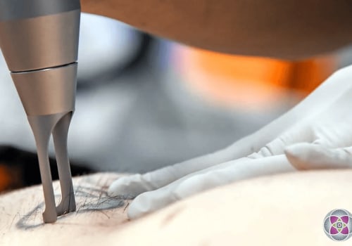 The Real Cost of Owning the Best Tattoo Removal Machine