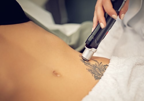 The Ultimate Guide to Choosing the Perfect Tattoo Removal Machine