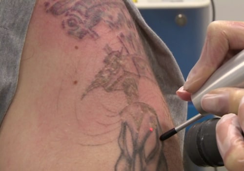 The Ultimate Guide to Choosing the Perfect Tattoo Removal Machine