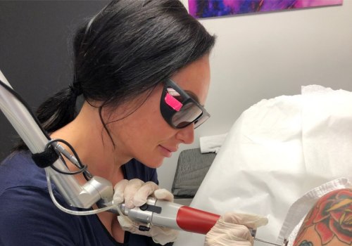 The Ultimate Guide to Choosing the Best Tattoo Removal Machine