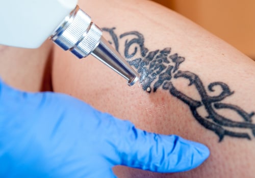 The Ultimate Guide to Choosing the Best Tattoo Removal Machine