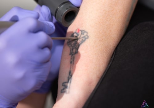 The Advancements in Tattoo Removal Technology