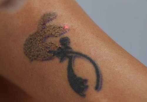 The Truth About Tattoo Removal: Debunking Myths and Understanding Risks