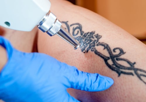 The Ultimate Guide to Tattoo Removal Machines: Can They Completely Remove a Tattoo?