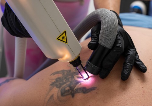 The Best Tattoo Removal Machine: What You Need to Know