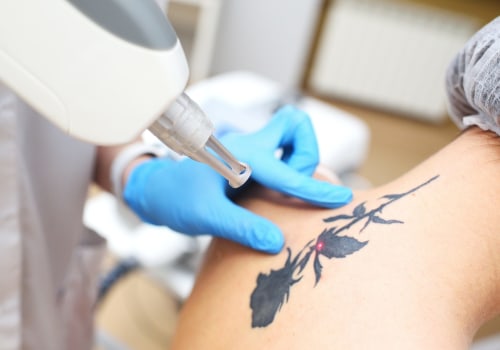 The Ins and Outs of Using a Tattoo Removal Machine