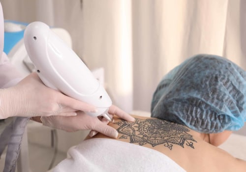 The Ultimate Guide to Financing a Tattoo Removal Machine