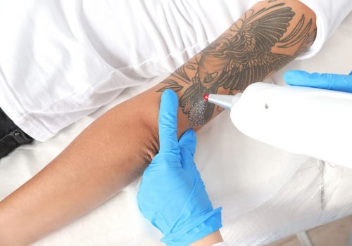 The Ultimate Guide to Proper Aftercare for Tattoo Removal Using the Best Machine