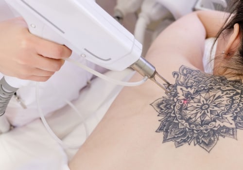 The Best Tattoo Removal Machine: A Comprehensive Guide