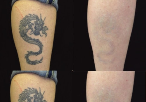 The Cost Comparison: Tattoo Removal Machine vs. Cover-Up Tattoo - Which is the Better Option?