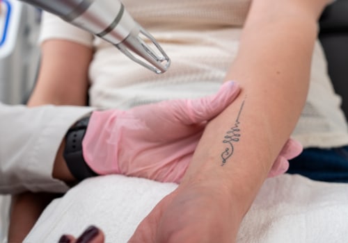 The Ultimate Guide to Choosing the Right Tattoo Removal Machine