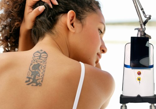The Truth About Tattoo Removal Machines: Is it Worth the Cost?