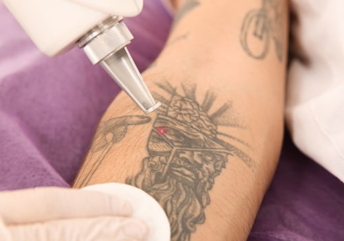 The Ultimate Guide to Removing Tattoos in Hard-to-Reach Areas