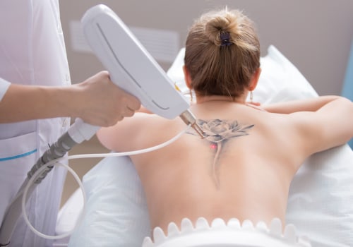 The Truth About Tattoo Removal Machines: Risks and Side Effects